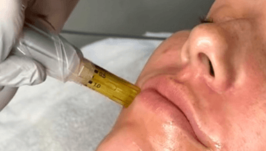 Image for Microneedling 60Min